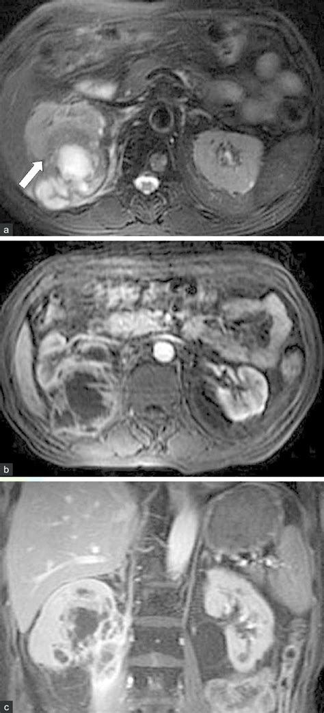 A common situation is the detection of a homogeneous hyperattenuating renal lesion on CT. . What is a t2 hyperintense lesion in kidney
